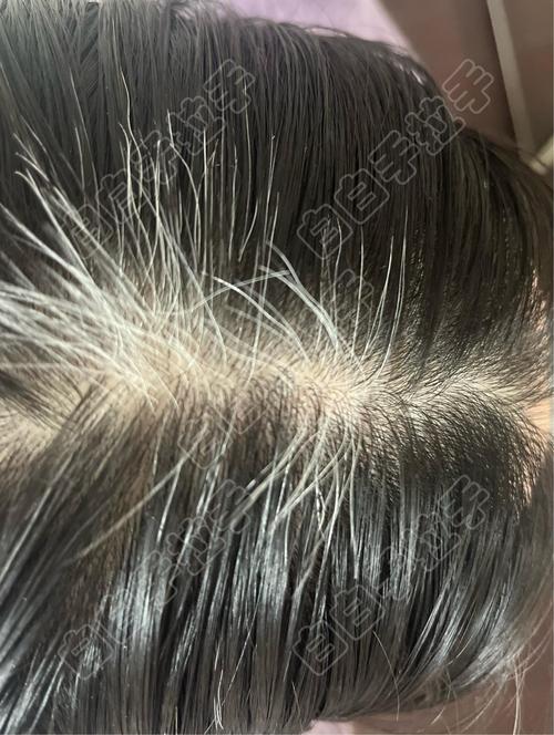 头发全白是什么病