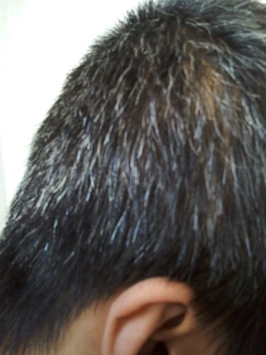 头发全白是什么病