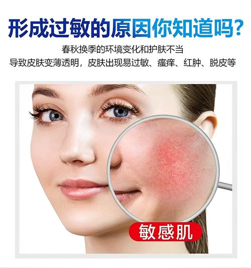 脸上过敏抹什么药