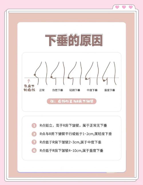 乳房为什么会下垂