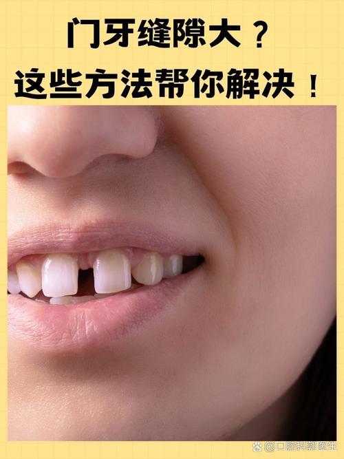 牙缝为什么越来越大