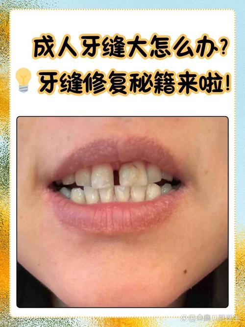 牙缝为什么越来越大
