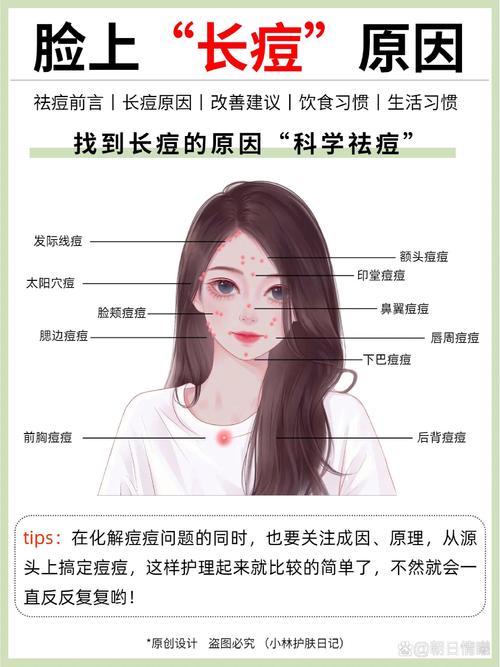 女生为什么会长痘