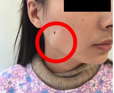 为什么咬肌会变大