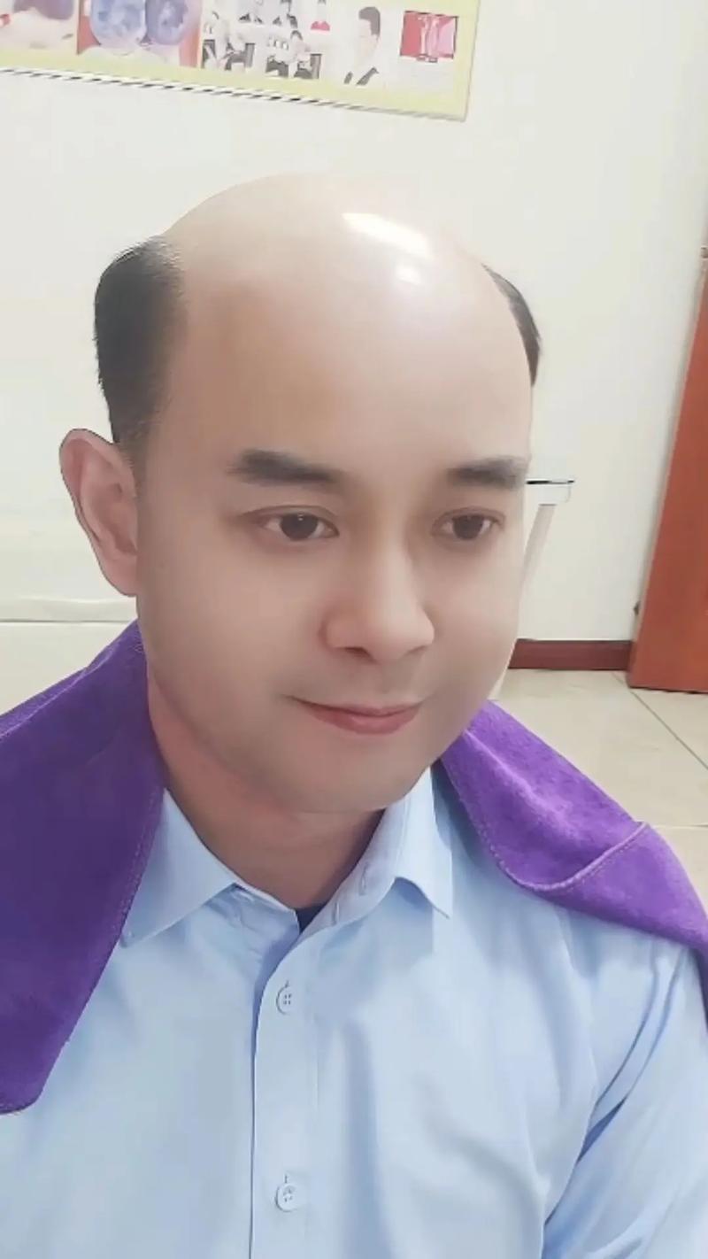 为什么男人会秃顶