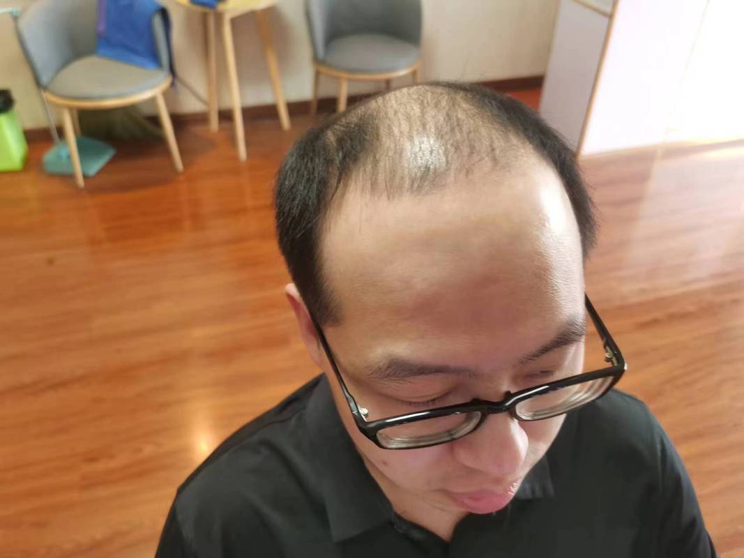 为什么男人会秃顶