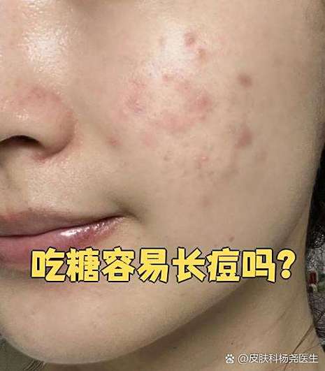 吃糖为什么会长痘