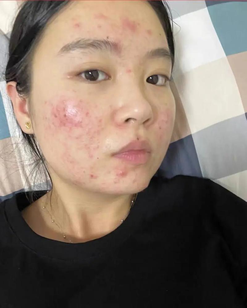 吃糖为什么会长痘