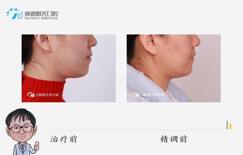 地包天有什么影响