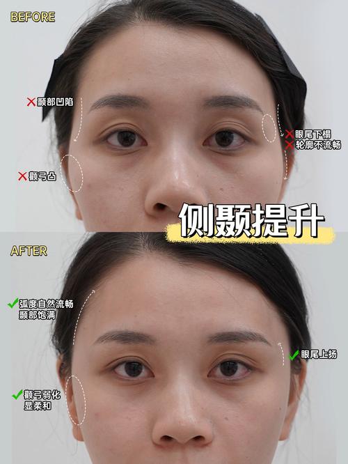 为什么太阳穴会凹陷