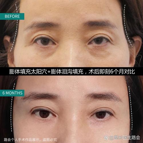 为什么太阳穴会凹陷