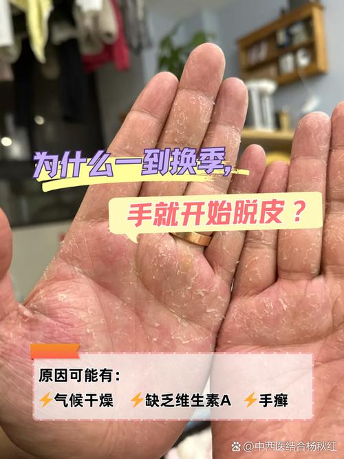 双手脱皮是什么原因