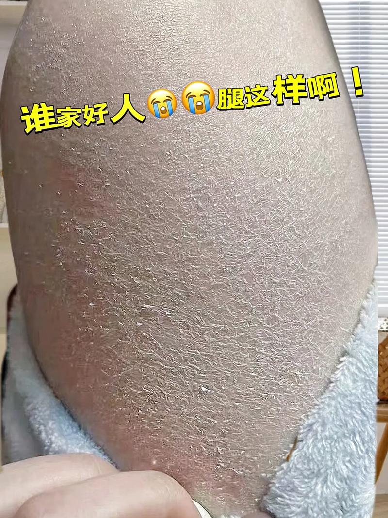 皮肤干燥起皮吃什么