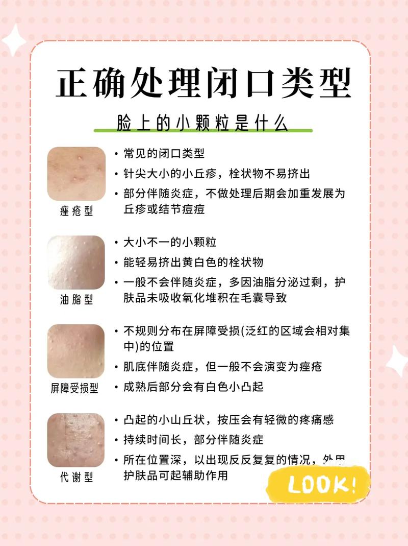 什么叫闭口粉刺