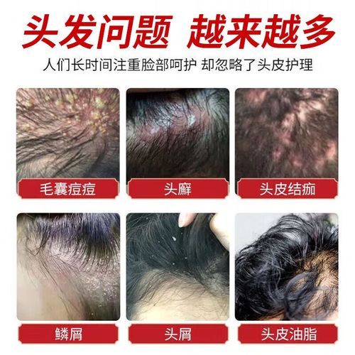 掉头发厉害吃什么药