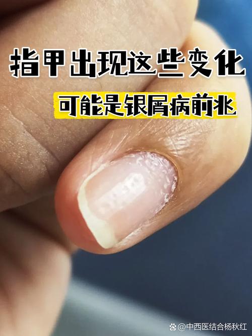 指甲白斑是什么原因
