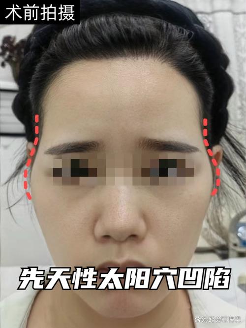 太阳穴为什么会凹陷