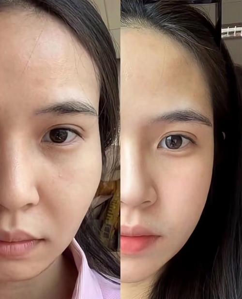 太阳穴为什么会凹陷