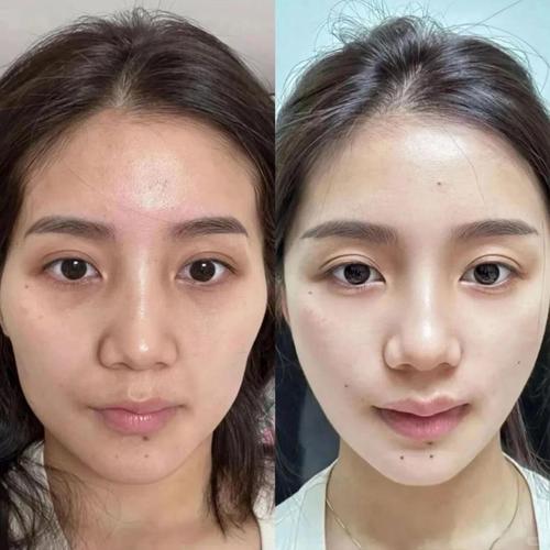 太阳穴为什么会凹陷