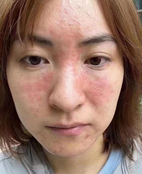 激素脸是什么样的