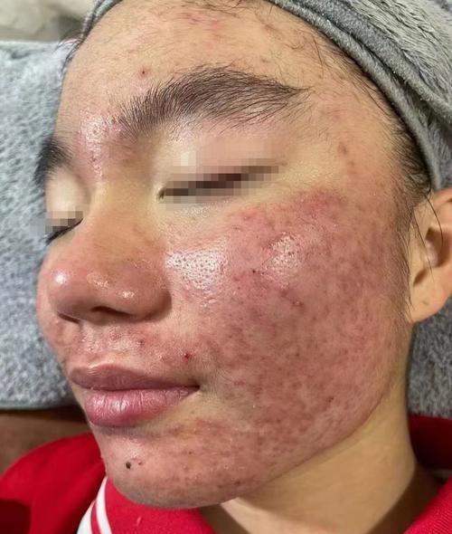 激素脸是什么样的