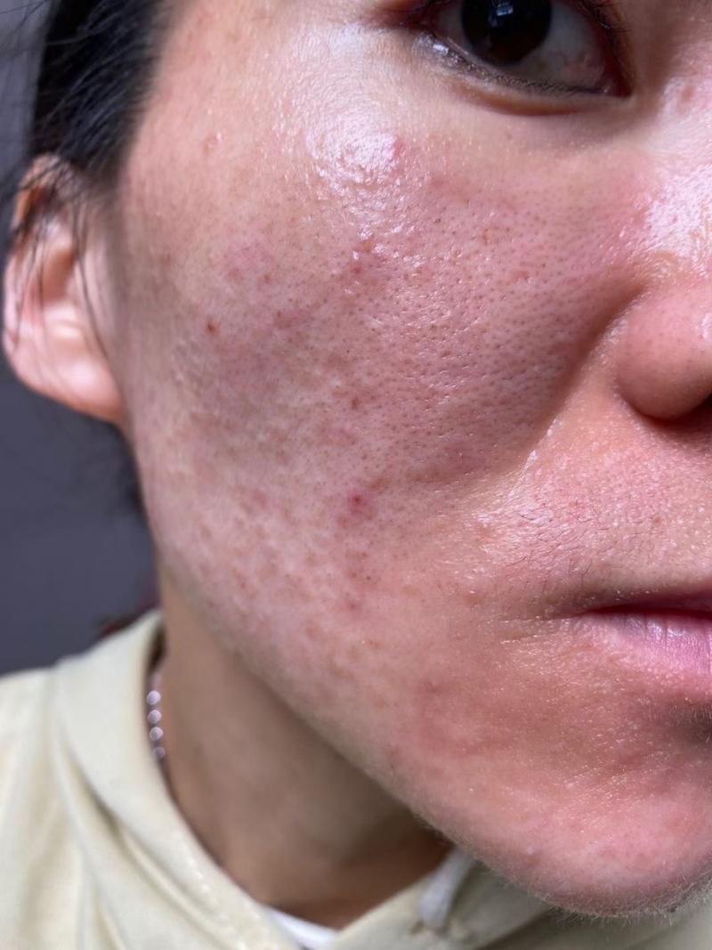 激素脸是什么样的