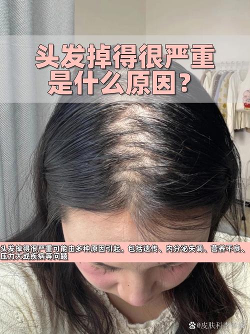 为什么减肥会掉头发是什么原因