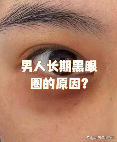 人为什么有黑眼圈