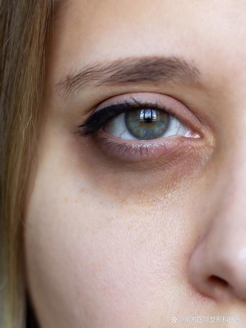 人为什么有黑眼圈