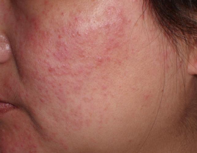 脸上过敏什么症状