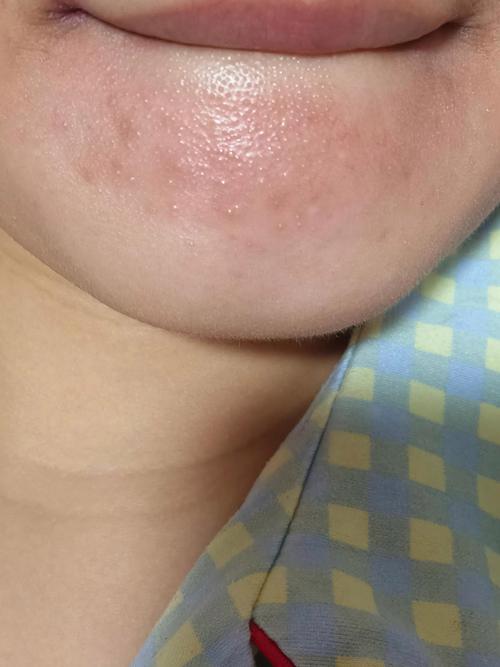 脸上过敏什么症状