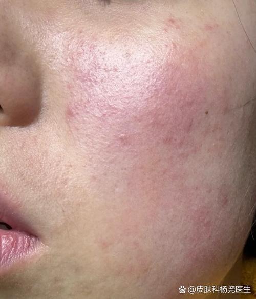 脸上过敏什么症状