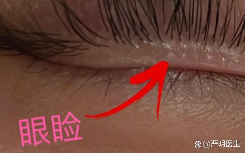 眼睑在什么位置