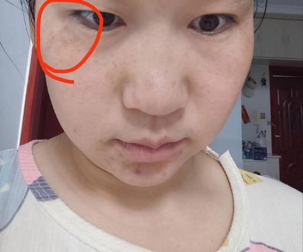 黄褐斑长什么样