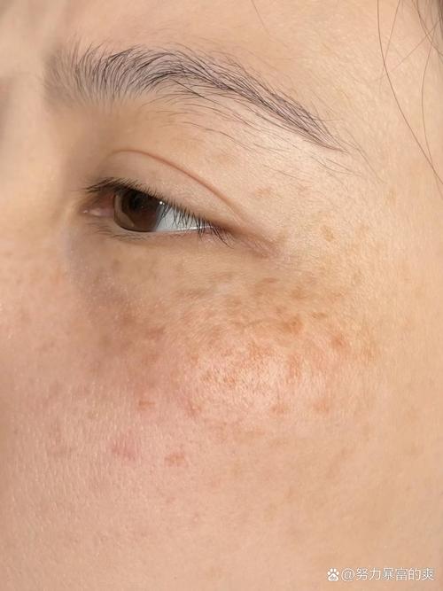 黄褐斑长什么样