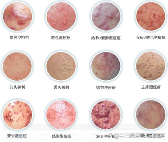 为什么脸上有粉刺