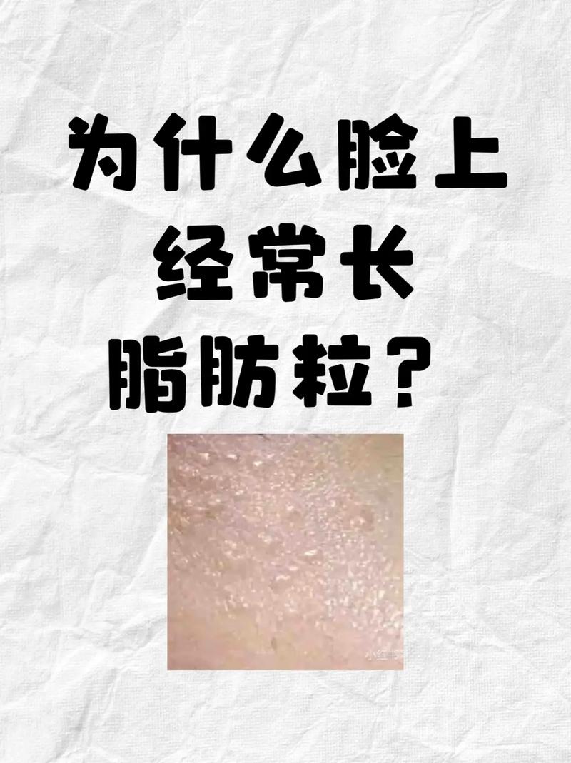 脸上为什么长脂肪粒