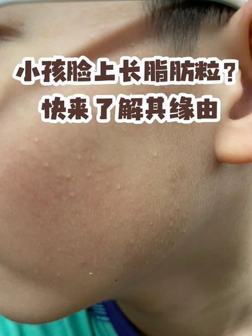 脸上为什么长脂肪粒