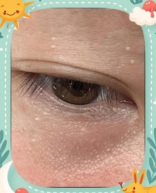 脸上为什么长脂肪粒