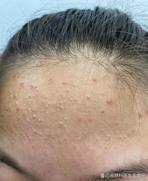 粉刺是什么样子的