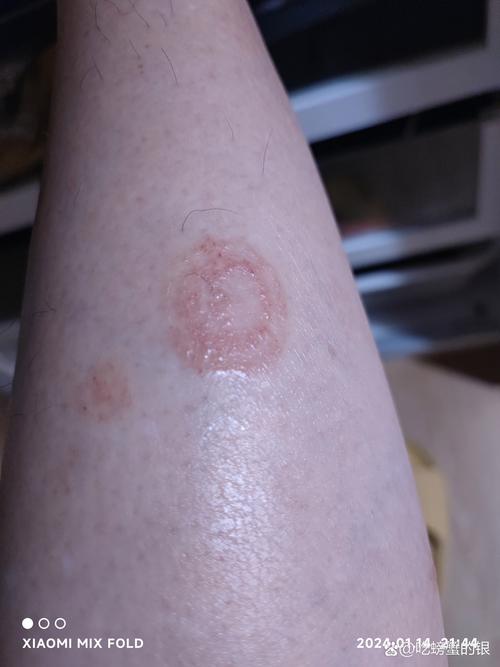 皮肤癣是什么症状