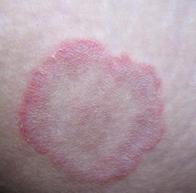 皮肤癣是什么症状