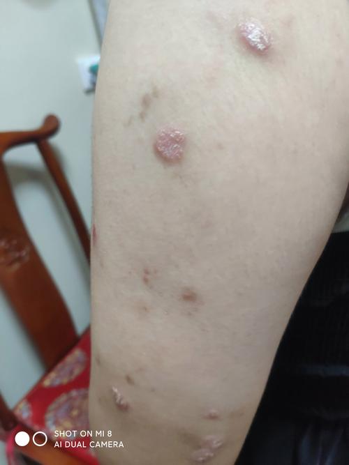 皮肤癣是什么症状