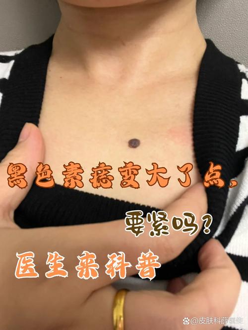 什么是黑色素痣