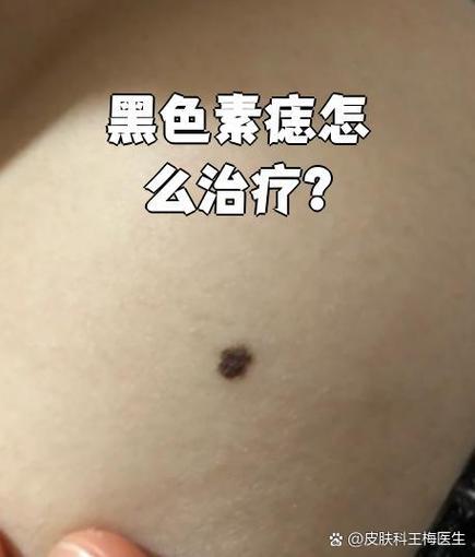 什么是黑色素痣