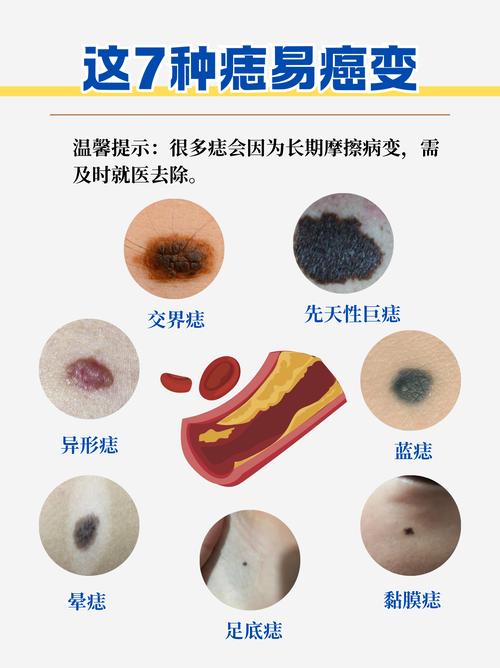 什么是黑色素痣