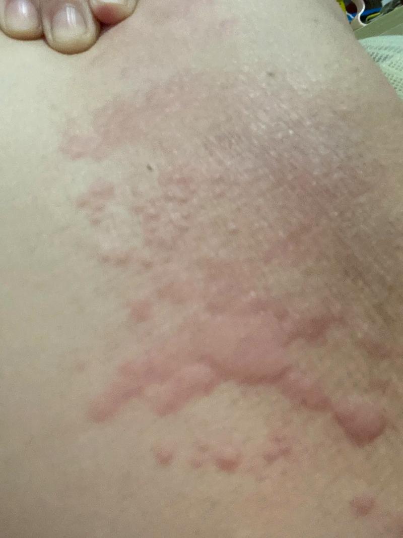 为什么皮肤老是过敏