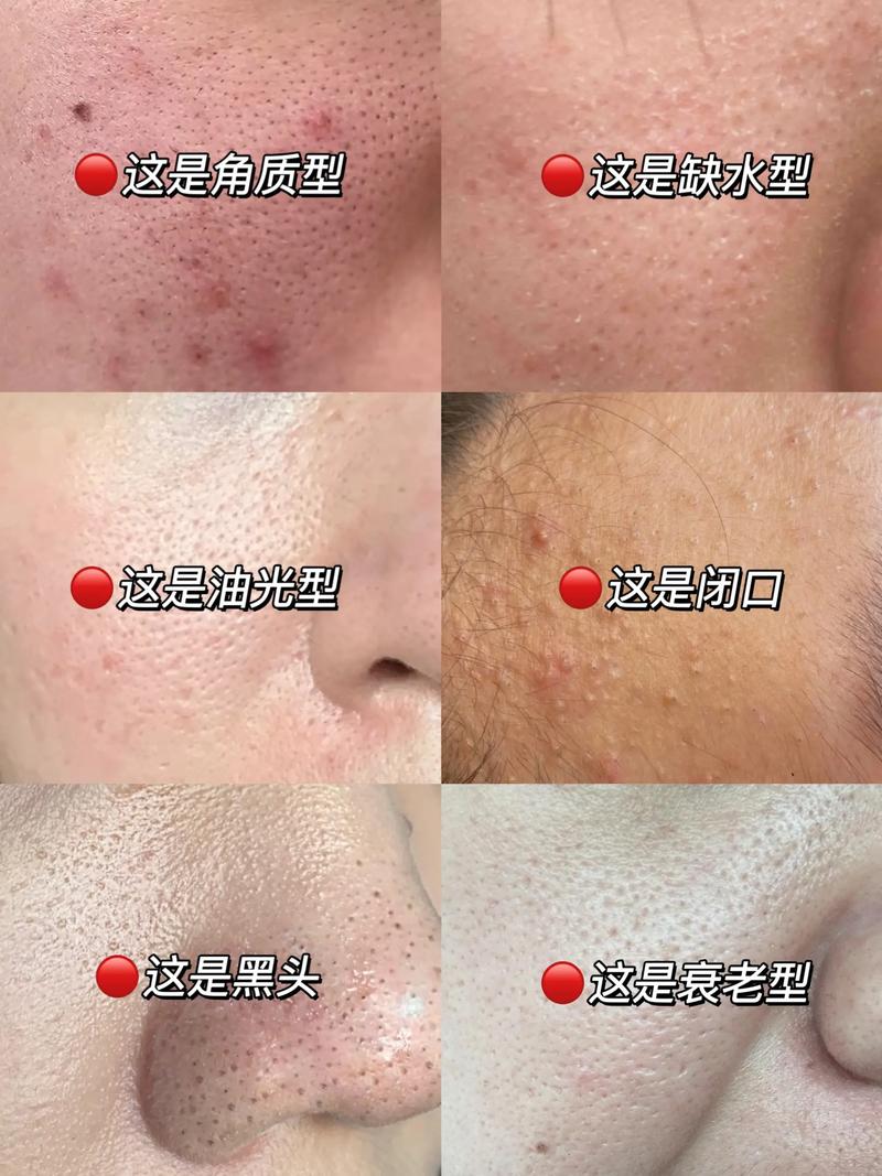 脸上为什么有毛孔