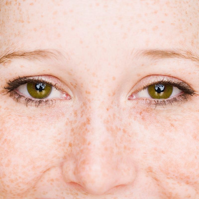 眼睛周围是什么斑