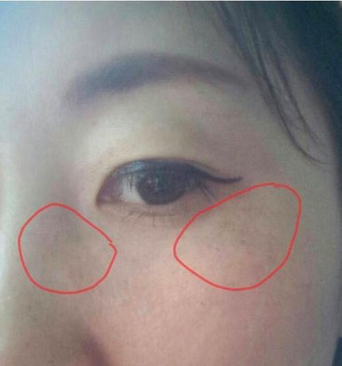 眼睛周围是什么斑